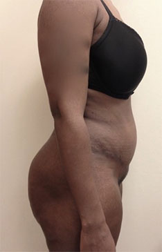 Abdominoplasty/ Tummy Tuck Patient #8 After Photo # 10