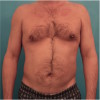 Male Liposuction Patient #2 Before Photo Thumbnail # 1