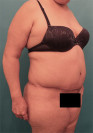 Abdominoplasty/ Tummy Tuck Patient #9 After Photo Thumbnail # 8