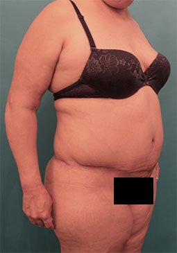 Abdominoplasty/ Tummy Tuck Patient #9 After Photo # 8