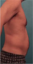 Male Liposuction Patient #2 Before Photo Thumbnail # 11