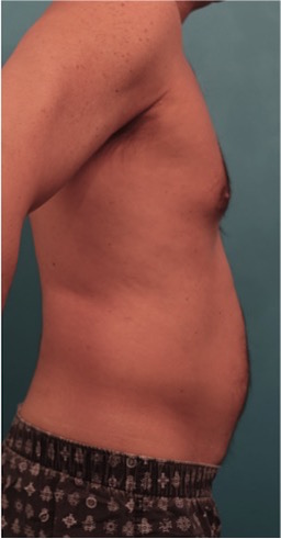 Male Liposuction Patient #2 Before Photo # 11