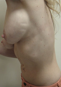 Breast Lift Patient #6 Before Photo # 11