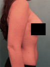 Liposuction Patient #6 After Photo Thumbnail # 6