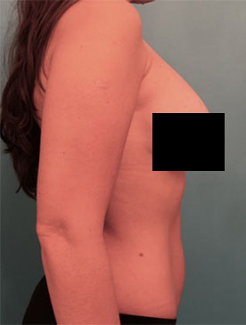 Liposuction Patient #6 After Photo # 6