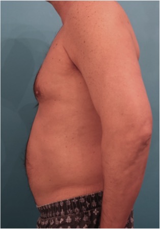 Male Liposuction Patient #2 Before Photo # 7