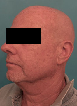 Male Laser Resurfacing Patient #1 Before Photo # 3