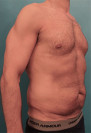 Male Abdominoplasty/Tummy Tuck Patient #1 Before Photo Thumbnail # 3