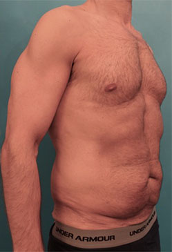 Male Abdominoplasty/Tummy Tuck Patient #1 Before Photo # 3