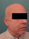 Male Laser Resurfacing Patient #1 After Photo Thumbnail # 8