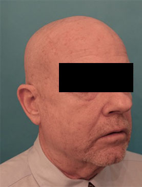Male Laser Resurfacing Patient #1 After Photo # 8