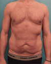 Male Abdominoplasty / Tummy Tuck Patient