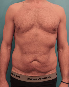 Male Abdominoplasty/Tummy Tuck Patient #1 Before Photo # 1