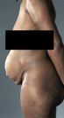 Abdominoplasty/ Tummy Tuck Patient #8 Before Photo Thumbnail # 5
