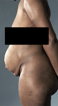Abdominoplasty/ Tummy Tuck Patient #8 Before Photo # 5