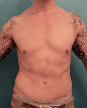 Male Abdominoplasty/Tummy Tuck Patient #2 After Photo # 2
