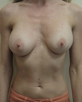 Breast Augmentation (Implants) Patient #10 Before Photo # 1