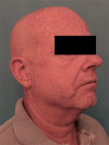 Male Laser Resurfacing Patient #1 Before Photo Thumbnail # 7