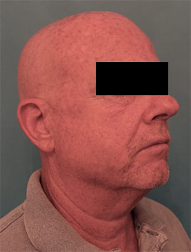 Male Laser Resurfacing Patient #1 Before Photo # 7