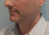 Male Kybella Patient #1 Before Photo Thumbnail # 7