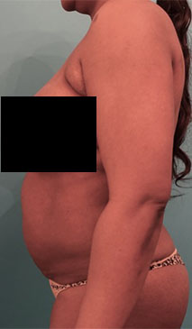 Abdominoplasty/ Tummy Tuck Patient #4 Before Photo # 5