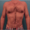 Male Liposuction Patient