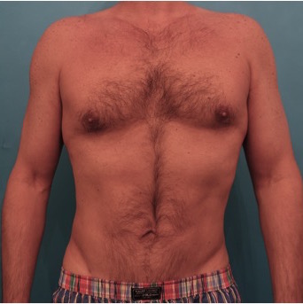 Male Liposuction Patient #2 After Photo # 2