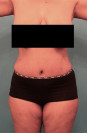 Abdominoplasty/ Tummy Tuck Patient #7 After Photo Thumbnail # 2