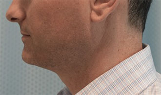 Male Kybella Patient #1 Before Photo # 5