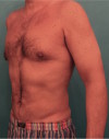 Male Liposuction Patient #2 After Photo Thumbnail # 6