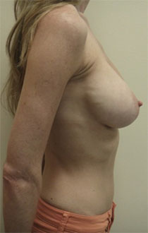 Breast Lift Patient #6 Before Photo # 5