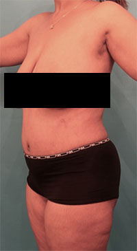 Abdominoplasty/ Tummy Tuck Patient #7 After Photo # 4