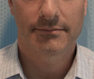 Male Kybella Patient #1 Before Photo # 1