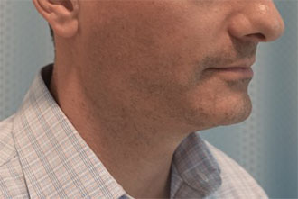Male Kybella Patient #1 Before Photo # 9