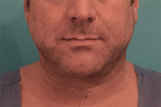 Male Kybella Patient #5 Before Photo # 1