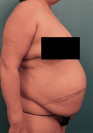 Abdominoplasty/ Tummy Tuck Patient #9 Before Photo Thumbnail # 7