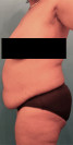 Abdominoplasty/ Tummy Tuck Patient #7 Before Photo Thumbnail # 5