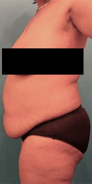 Abdominoplasty/ Tummy Tuck Patient #7 Before Photo # 5