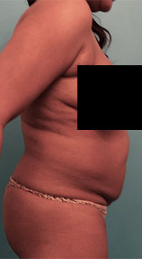 Abdominoplasty/ Tummy Tuck Patient #4 Before Photo # 9