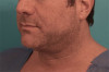 Male Kybella Patient #5 Before Photo Thumbnail # 7