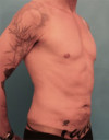 Male Abdominoplasty/Tummy Tuck Patient #2 Before Photo Thumbnail # 5