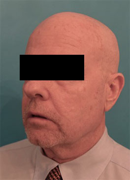 Male Laser Resurfacing Patient #1 After Photo # 4