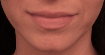 Lip Filler Patient #5 Before Photo # 1