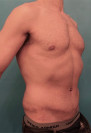 Male Abdominoplasty/Tummy Tuck Patient #1 After Photo Thumbnail # 4