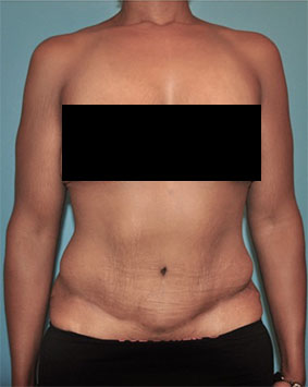 Abdominoplasty/ Tummy Tuck Patient #6 After Photo # 2