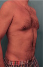 Male Liposuction Patient #2 After Photo Thumbnail # 10
