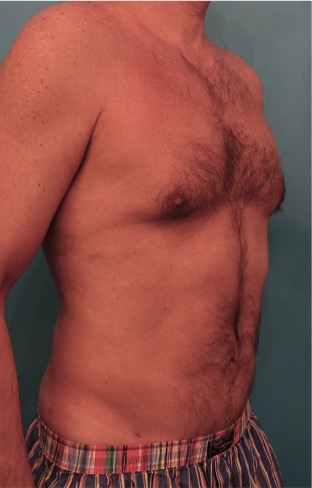 Male Liposuction Patient #2 After Photo # 10