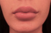 Lip Filler Patient #6 After Photo Thumbnail # 2