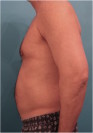 Liposuction Patient #1 Before Photo Thumbnail # 7