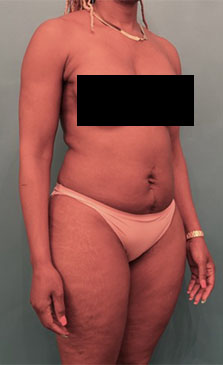 Liposuction Patient #5 Before Photo # 9